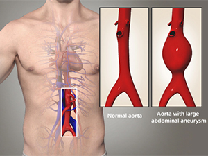Abdominal Aortic Aneurysm Endovascular Repair Treatment Sydney