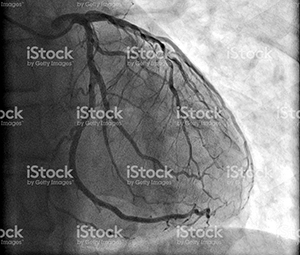 Angiogram