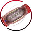 Angioplasty, Atherectomy and Stenting