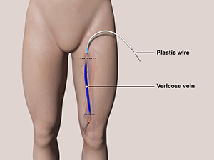 Varicose Vein Surgery