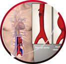 Abdominal Aortic Aneurysm Endovascular Repair