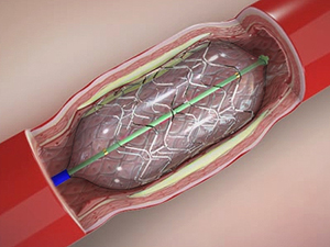Angioplasty, Atherectomy and Stenting