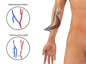 Arteriovenous Fistula Creation for Dialysis Access