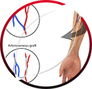 Arteriovenous Fistula Creation for Dialysis Access