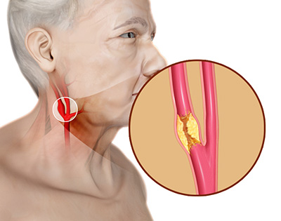 Carotid Artery Disease