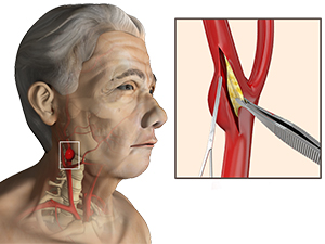 endarterectomy