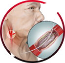 Carotid Stenting