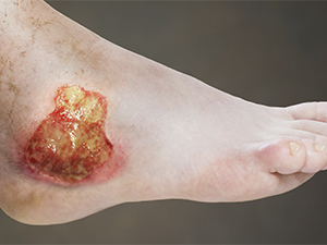 Chronic / Non-healing Wound Management