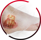 Chronic/Non-healing Wound Management