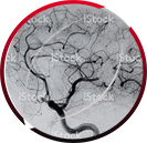 CT Angiography
