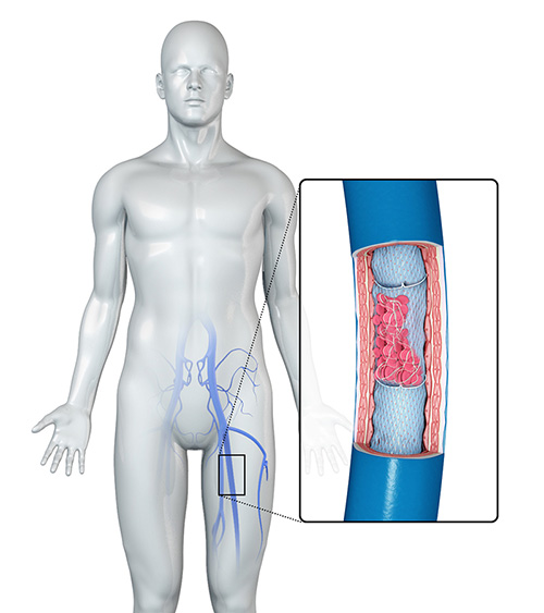 Deep Vein Thrombosis