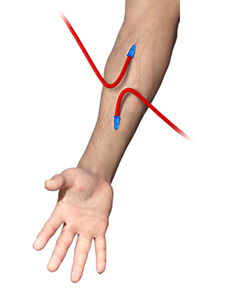 fistula for dialysis placement