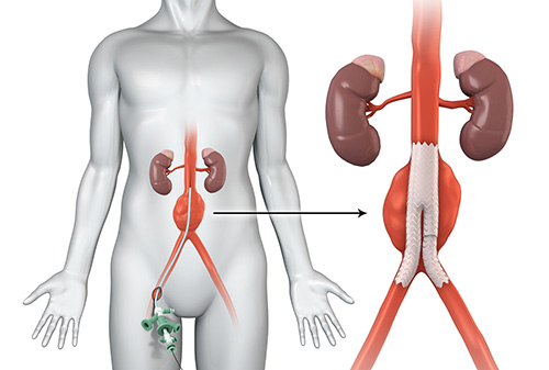 Endovascular Aneurysm Repair (EVAR)