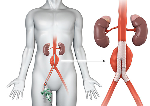 Endovascular Aneurysm Repair (EVAR)