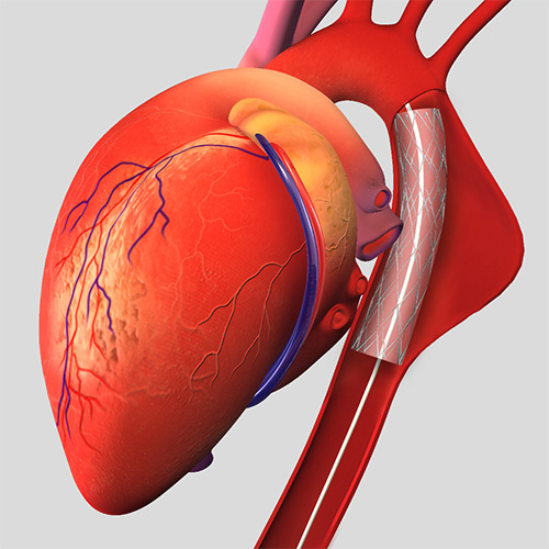 Endovascular Aneurysm Repair (EVAR)