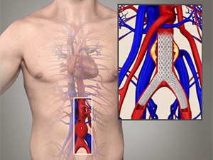 Endovascular Stent Graft