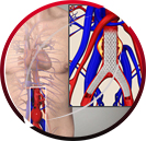 Endovascular Stent Graft