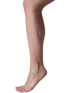 Endovenous Laser Therapy