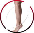 Endovenous Laser Therapy