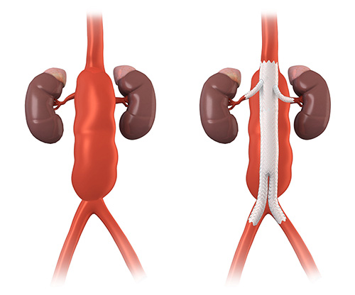 Fenestrated Endovascular Aneurysm Repair