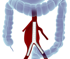 Mesenteric Aneurysms Endovascular Repair