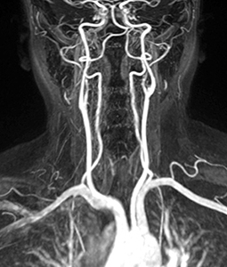 MR Angiogram