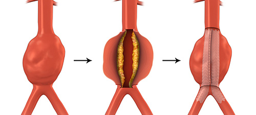 Endovascular Aneurysm Repair (EVAR)