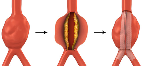 Open Aneurysm Repair