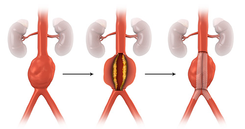 Open Aneurysm Repair