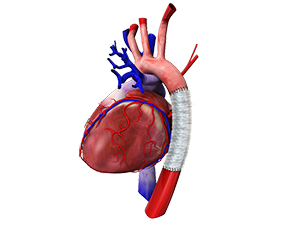 Open Surgical Aneurysm Repair