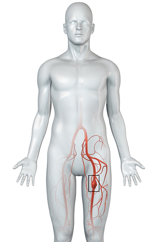 Peripheral Arterial Aneurysm