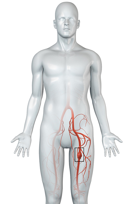 Peripheral Arterial Aneurysm