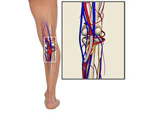 Popliteal Arterial Aneurysm Endovascular Repair