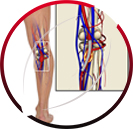 Popliteal Arterial Aneurysm Endovascular Repair