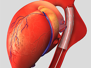 Surgical Aneurysm Repair