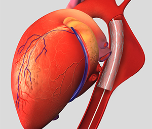 Thoracic Aortic Aneurysm Endovascular Repair