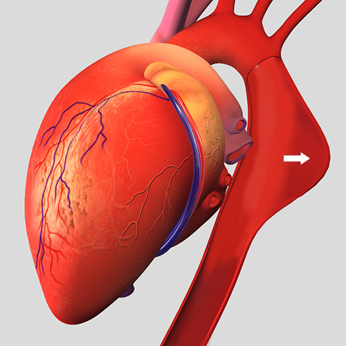 Thoracic Aortic Aneurysm