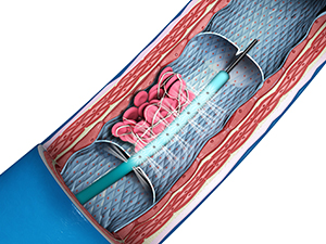 Thrombolytic Therapy