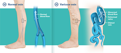 Could your Restless Leg Syndrome really be venous disease?